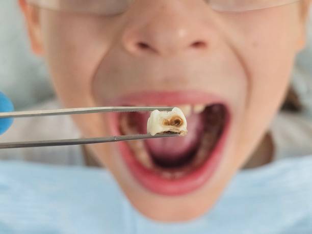 Best Emergency Tooth Extraction in Centerville, MN